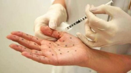 Injection de botox pour le traitement de la transpiration excessive des mains